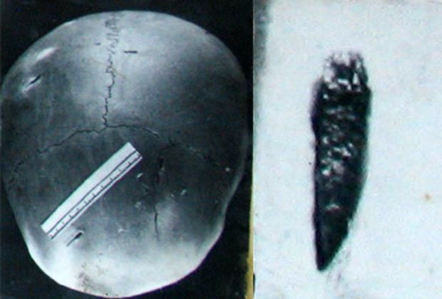 Череп Герты Грибановой и извлеченный фрагмент ножа Фото: из материалов дела