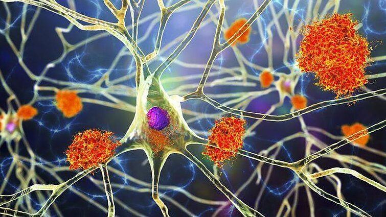 Примерно так выглядят нервные клетки, покрытые белковыми бляшками / фото GETTY IMAGES