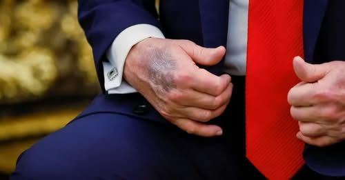 Синяк на руке президента Трампа во время встречи с президентом Южной Кореи Ли Чжэ Мёном в Овальном кабинете Белого дома, 25 августа 2025 года / Reuters