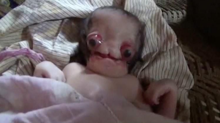 Скриншот видео BABY BORN WITH SEVERE DEFORMITY IS COMPARED TO 'ALIEN'