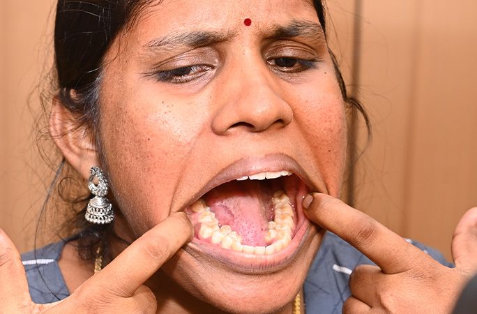 Жительница Индии Калпана Балан побила мировой рекорд по количеству зубов среди женщин. Обложка © guinnessworldrecords